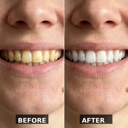 JustSmile Teeth Whitening Kit